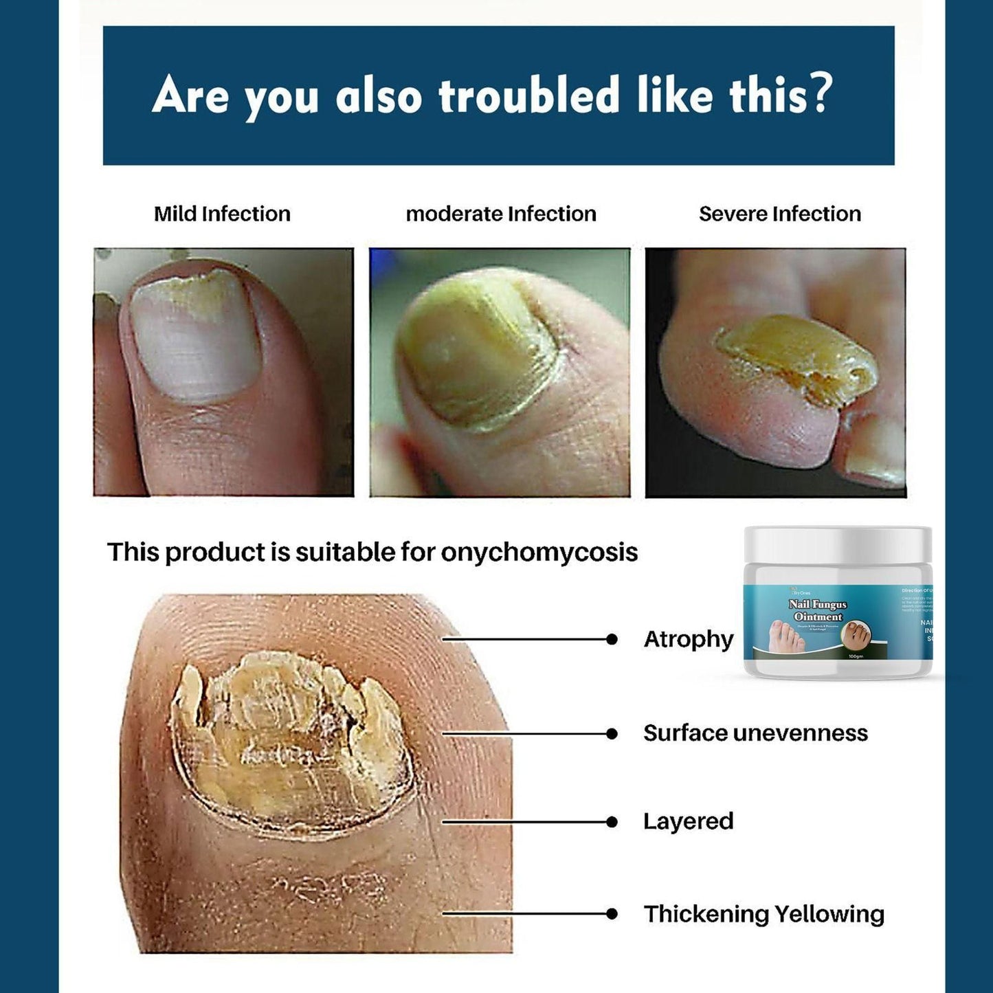 Nail Fungus Ointment